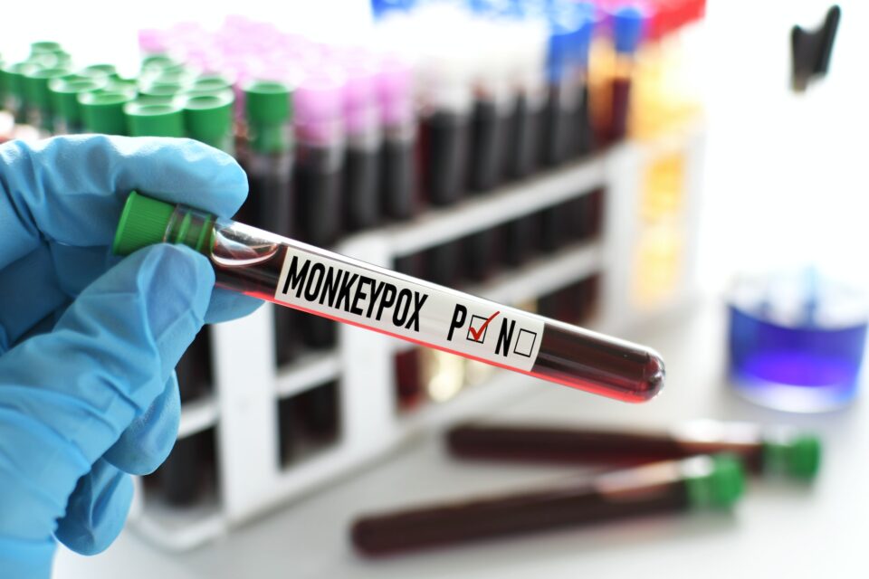 A medical worker lab technician holding a vial of blood to tested for the monkeypox virus – positive